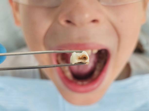 Best Emergency Treatment for Dental Infections or Abscesses in Loganville, PA